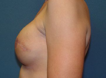 breast reconstruction post op