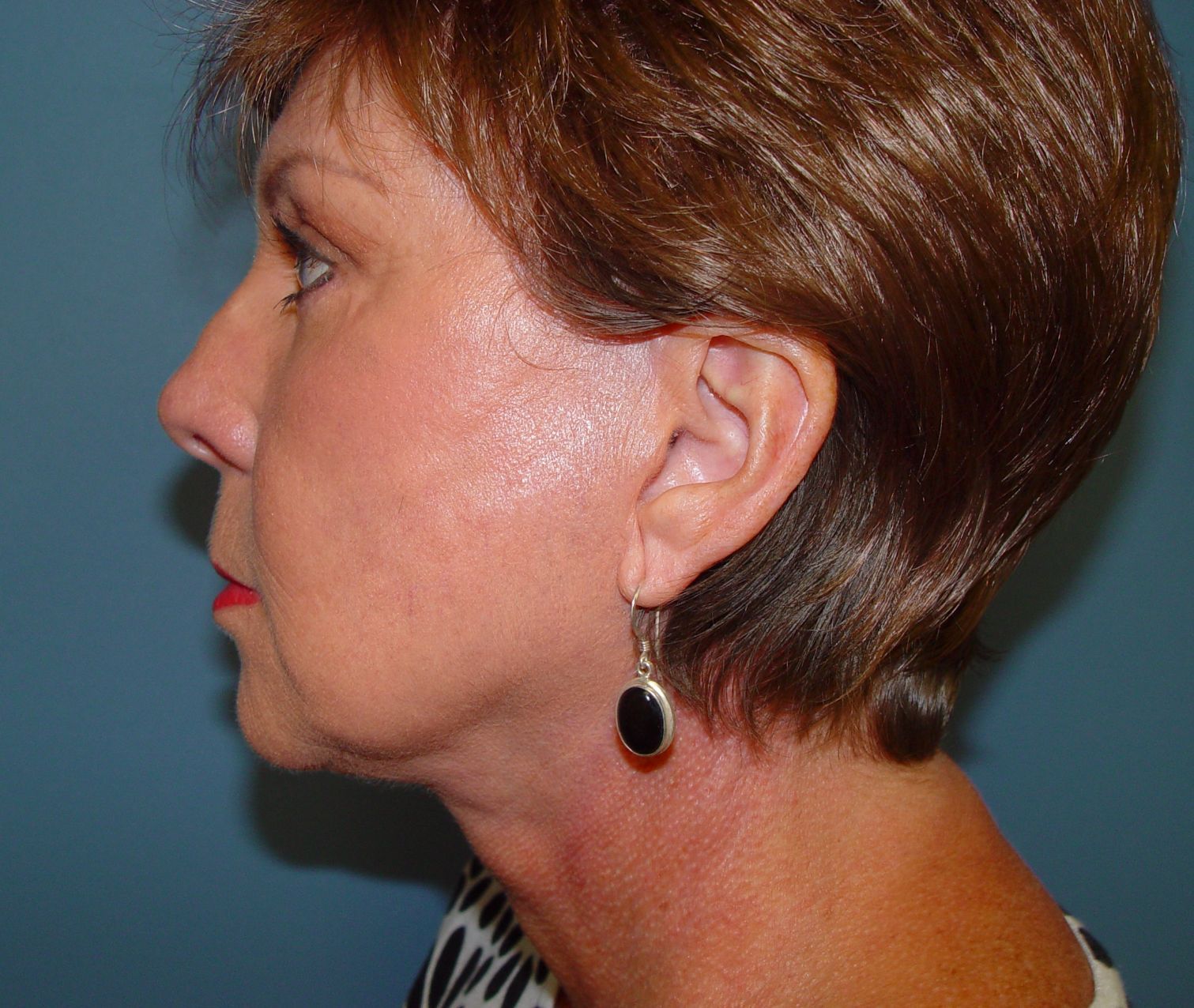 Plastic surgery facelift post-op
