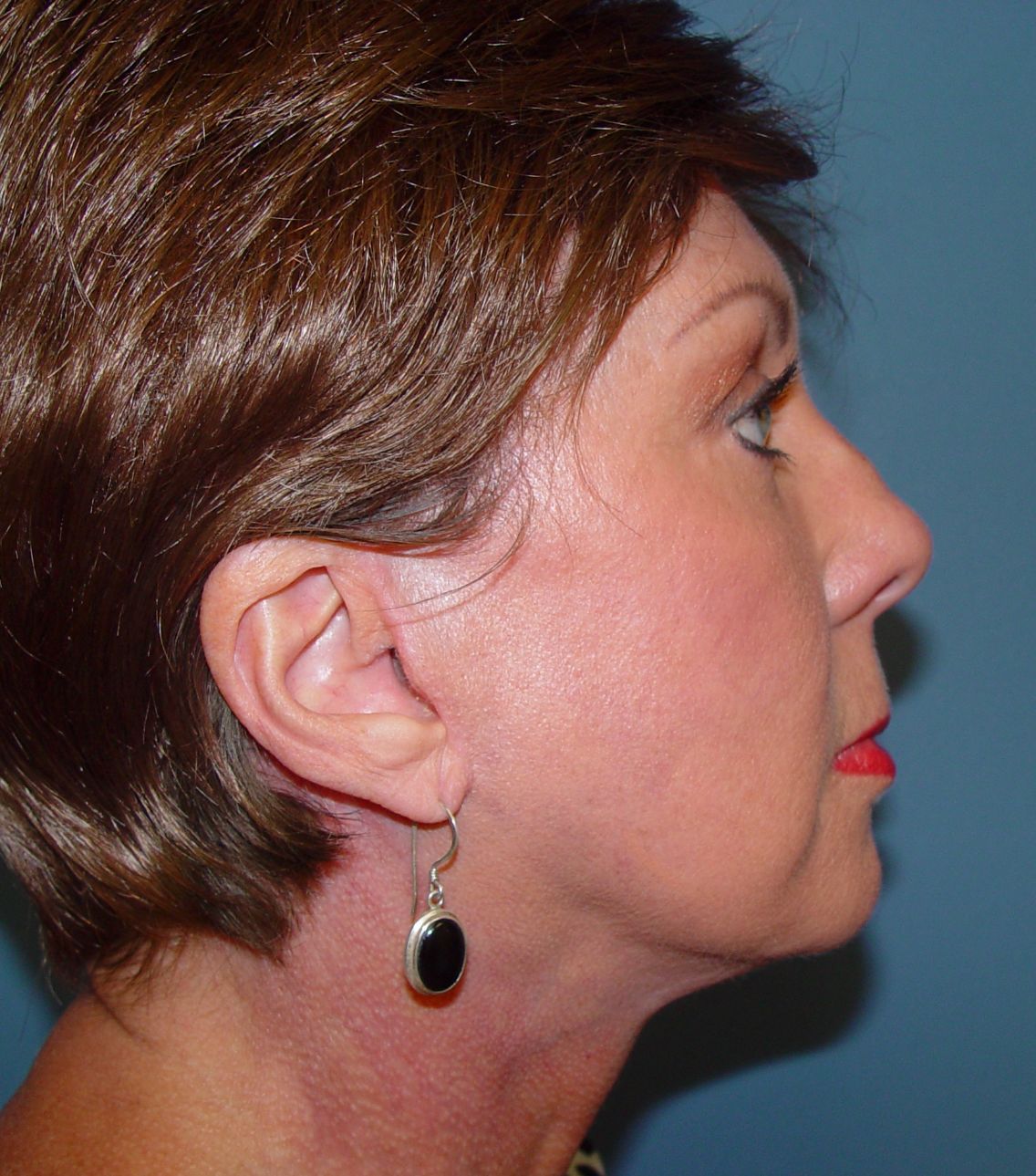 Plastic surgery facelift post-op