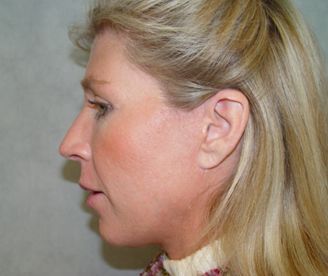 Plastic surgery facelift post-op