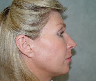 Plastic surgery facelift post-op