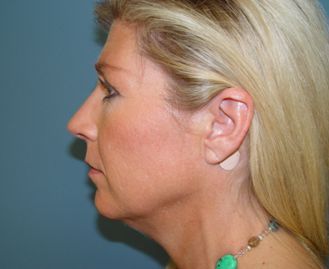 Plastic surgery facelift post-op