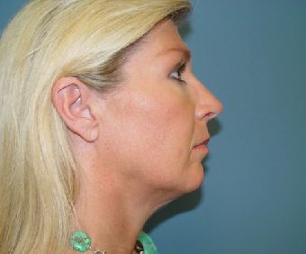 Plastic surgery facelift post-op