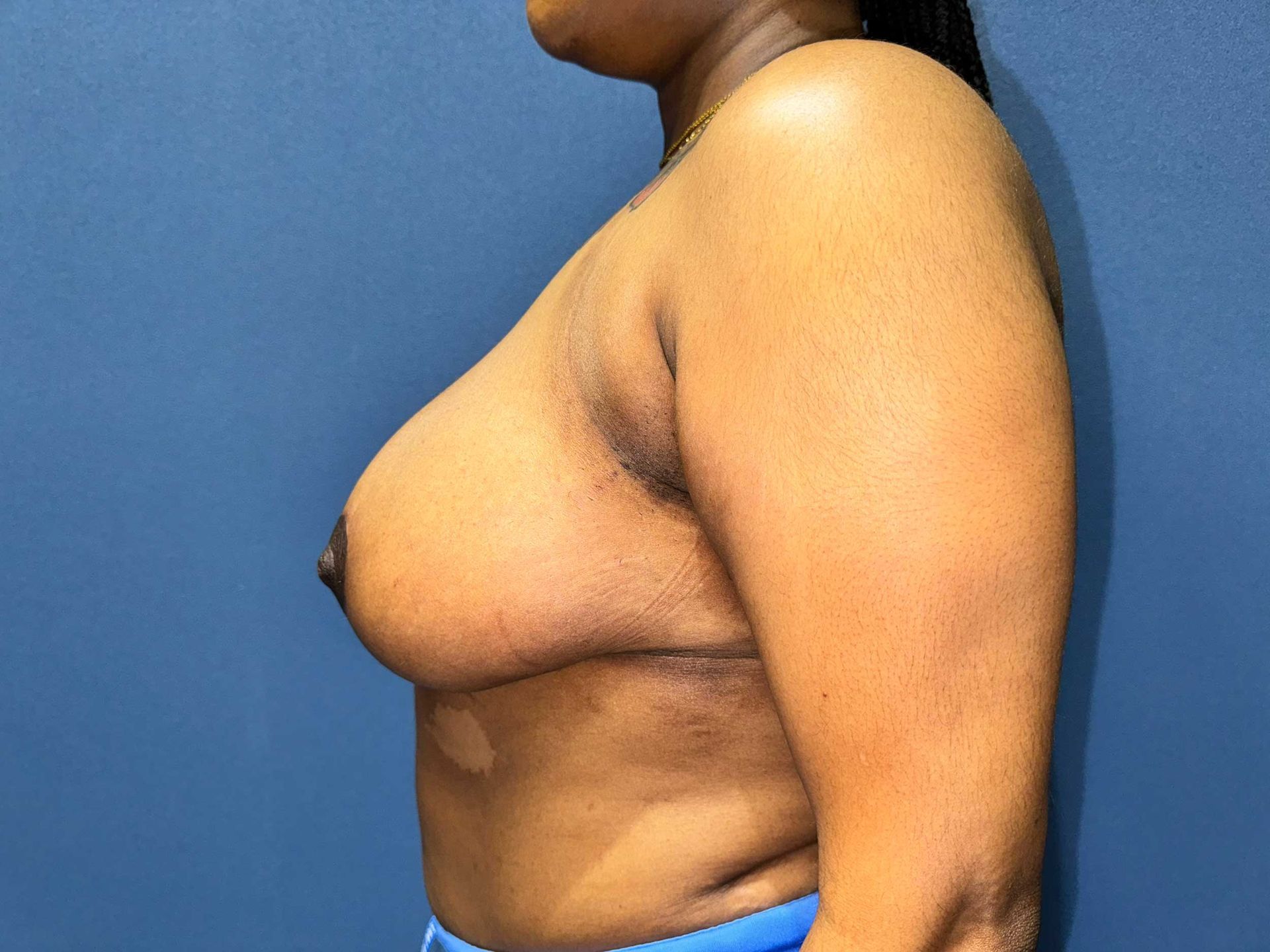 breast reduction surgery charleston