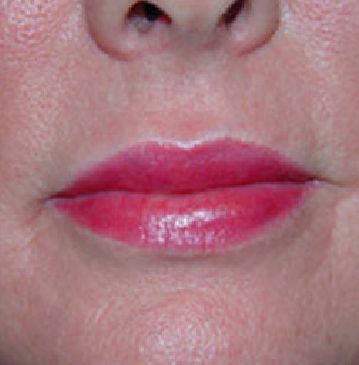 lip filler charleston