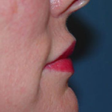 lip filler charleston