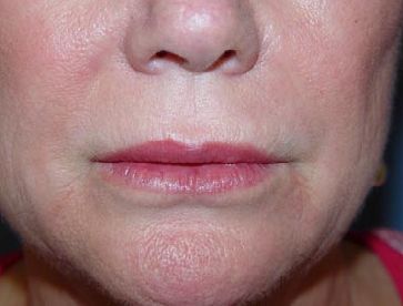 lip filler charleston