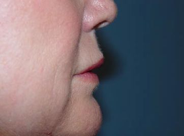 lip filler charleston