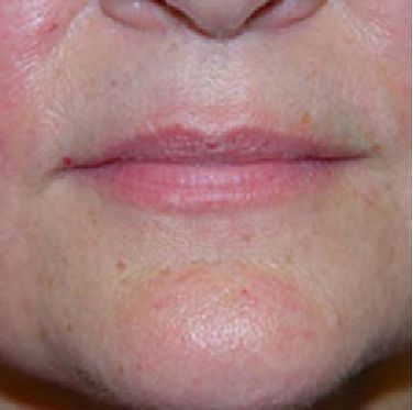 A close up of a woman 's face with red spots on her face.