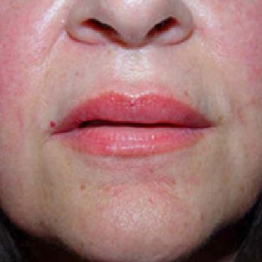 lip filler charleston