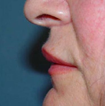 lip surgery charleston