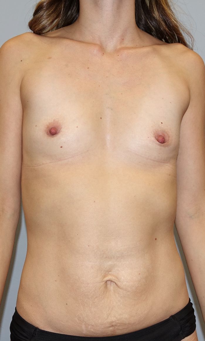 mommy makeover pre op