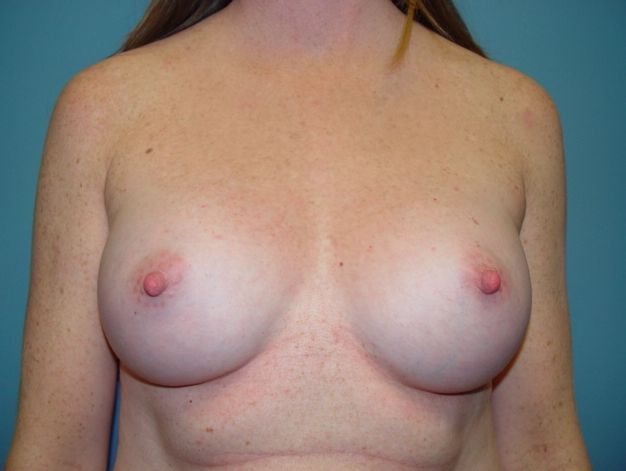 mommy makeover post op