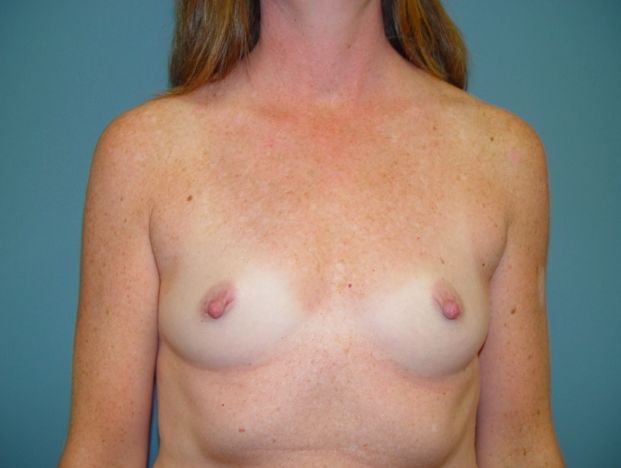 mommy makeover pre op