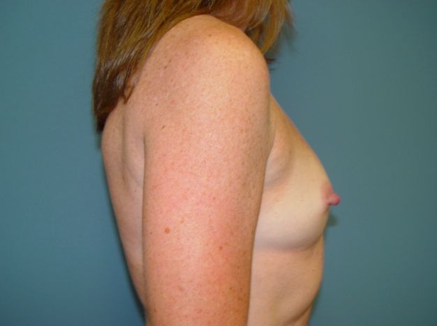 mommy makeover post op