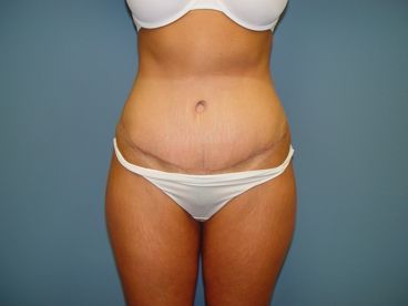 dr kalus mommy makeover charleston post op