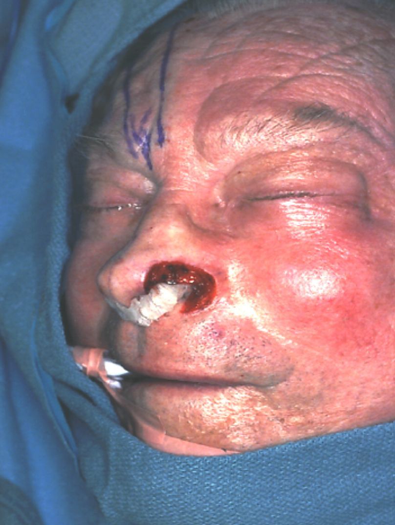 nasal reconstruction