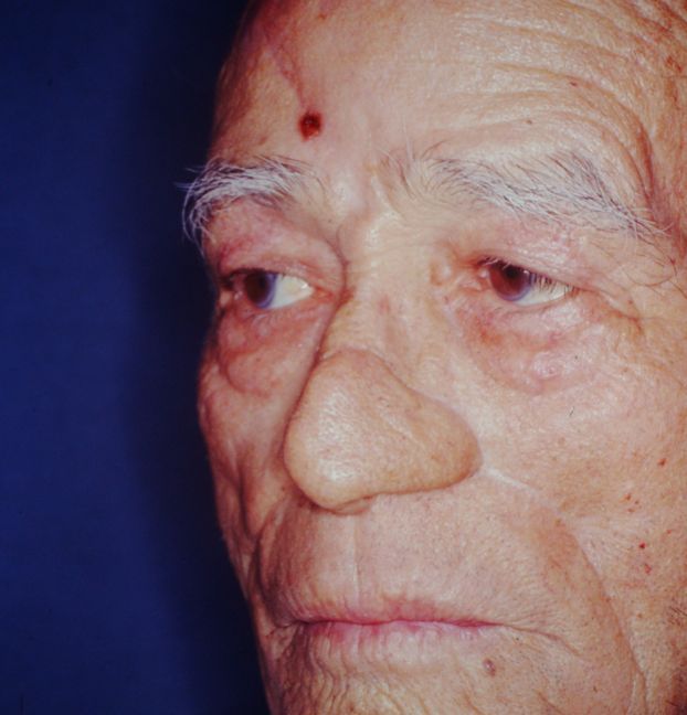 A close up of an older man 's face with a red spot on his forehead