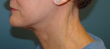 neck lift post op charleston