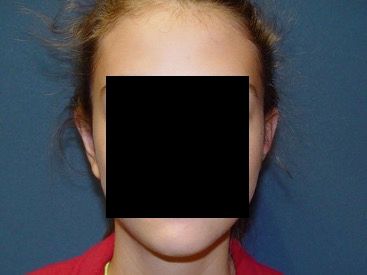 otoplasty post-op