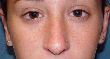 otoplasty post-op