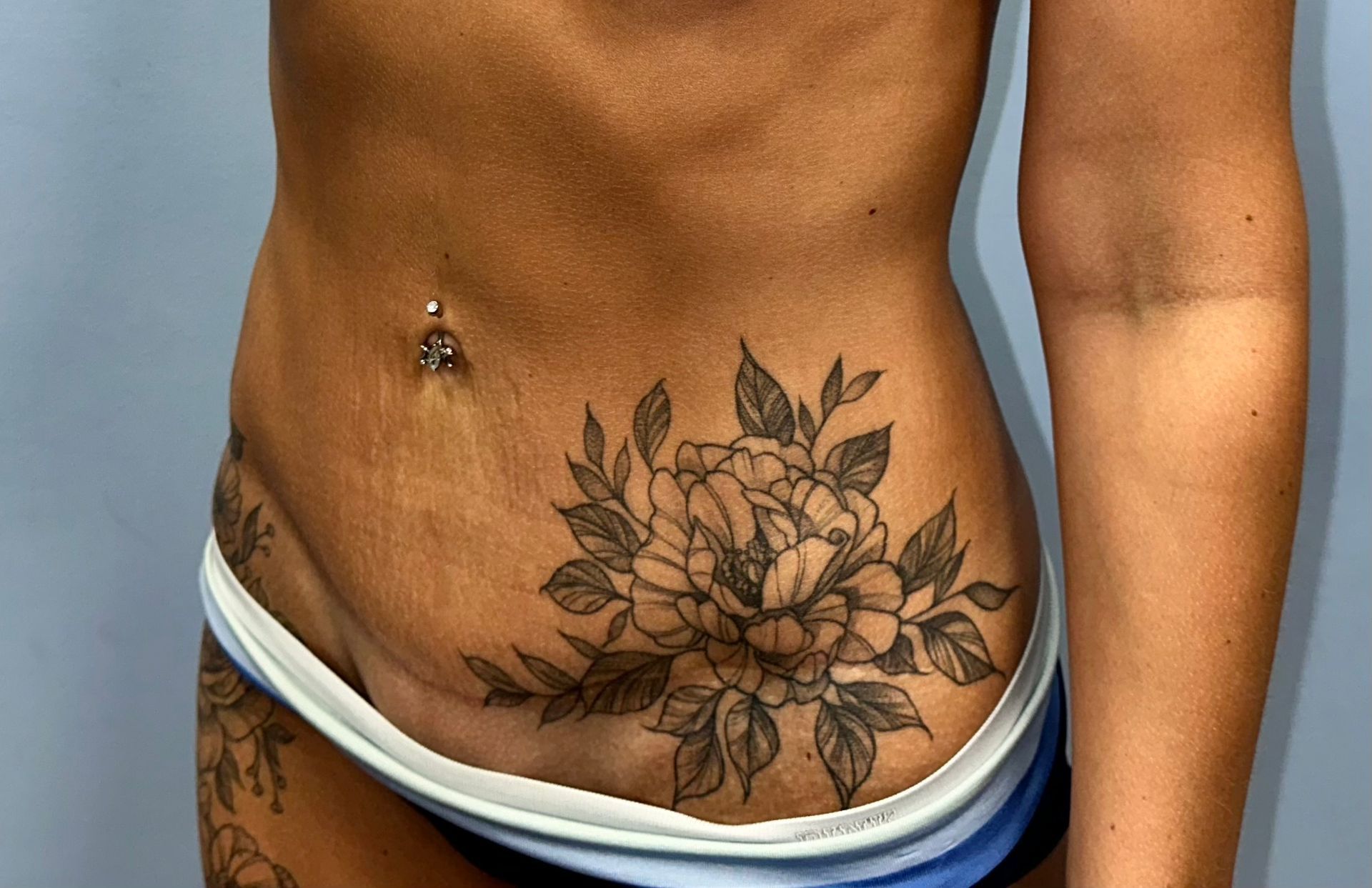 dr kalus mommy makeover charleston post op