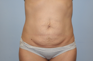 A woman 's stomach is shown in white underwear against a blue background.