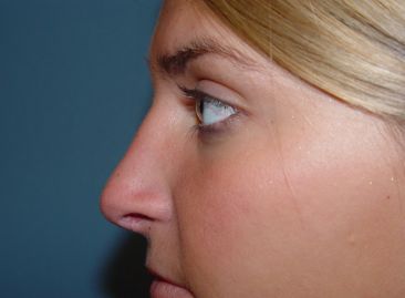 rhinoplasty post op charleston