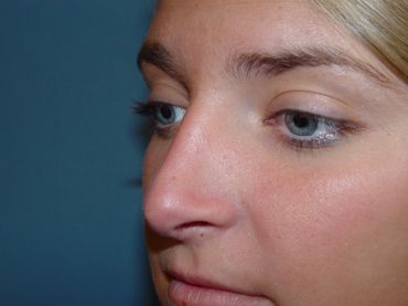 rhinoplasty post op charleston