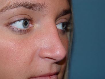 rhinoplasty post op charleston