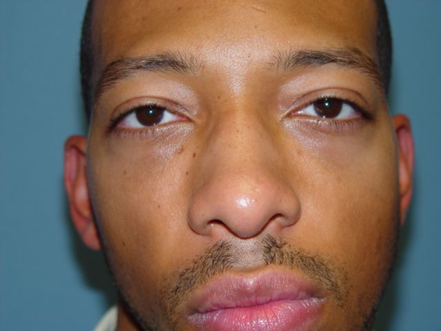 rhinoplasty post op charleston