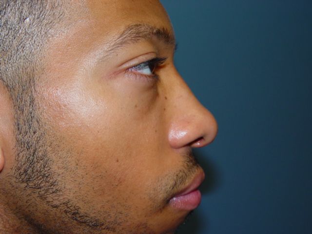 rhinoplasty post op charleston