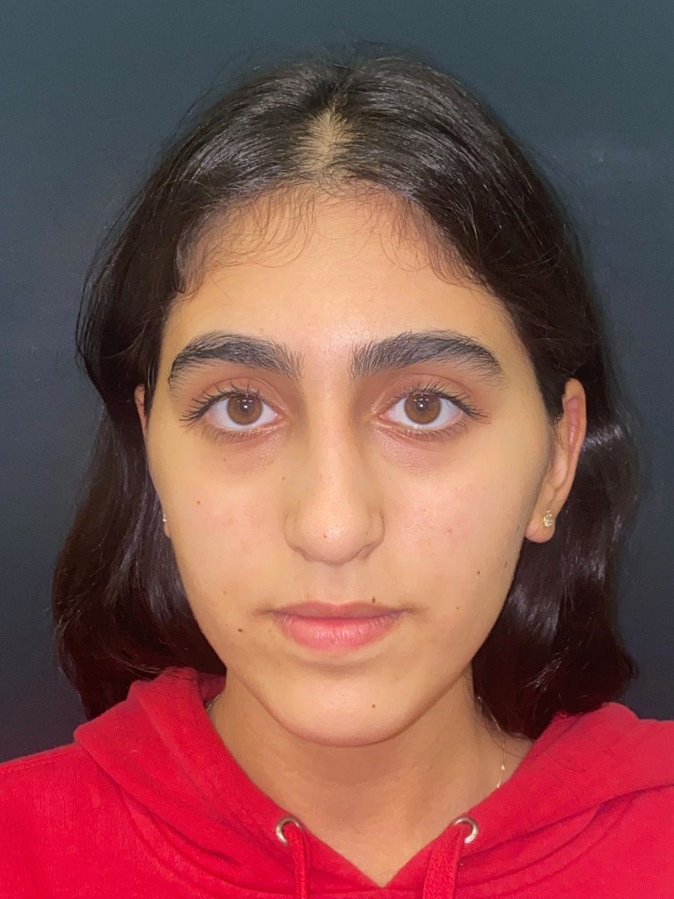 rhinoplasty post op charleston