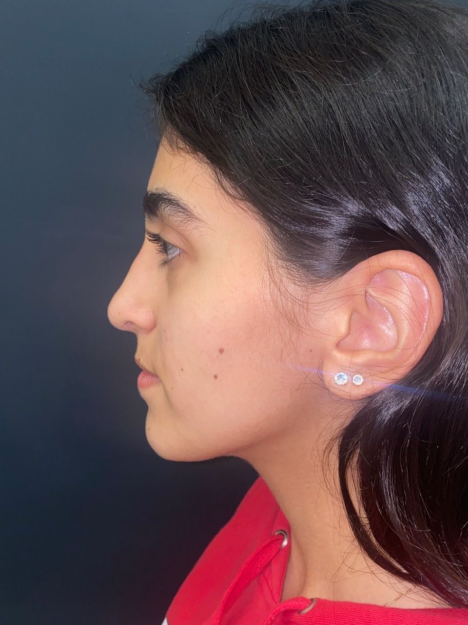 rhinoplasty post op charleston