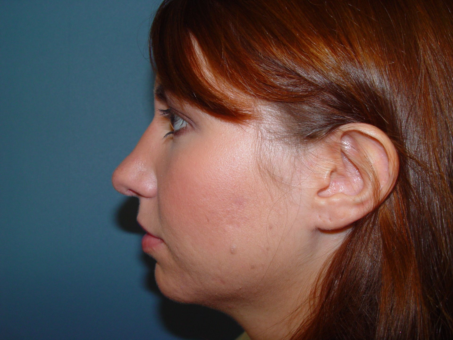 rhinoplasty post op charleston