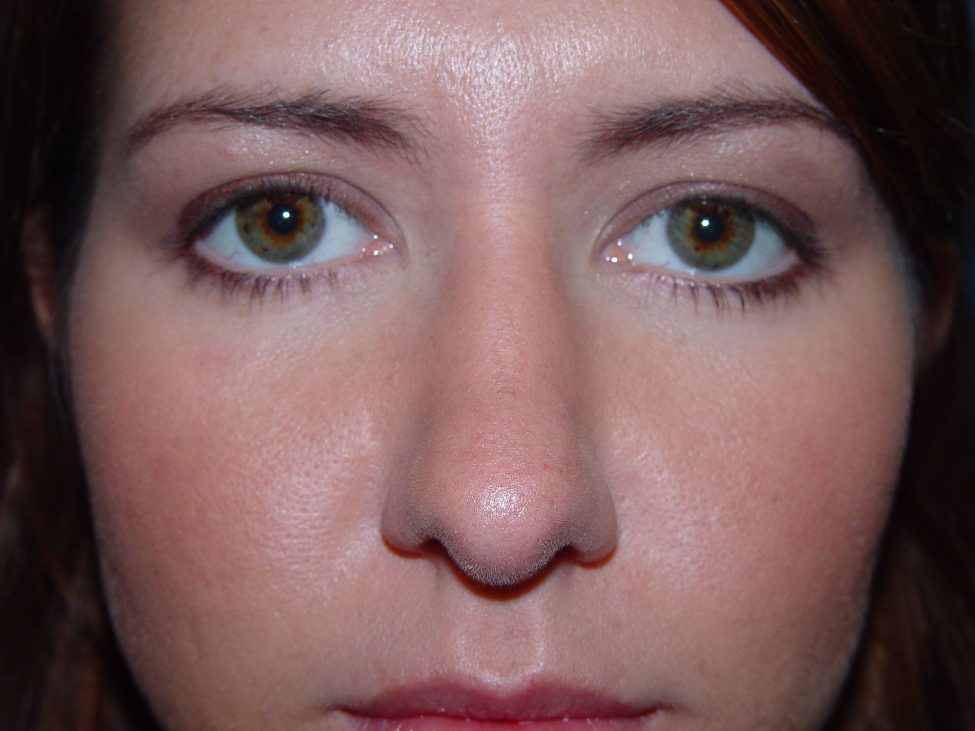 rhinoplasty post op charleston