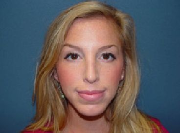 rhinoplasty post op charleston