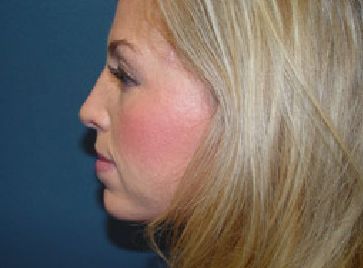 rhinoplasty post op charleston
