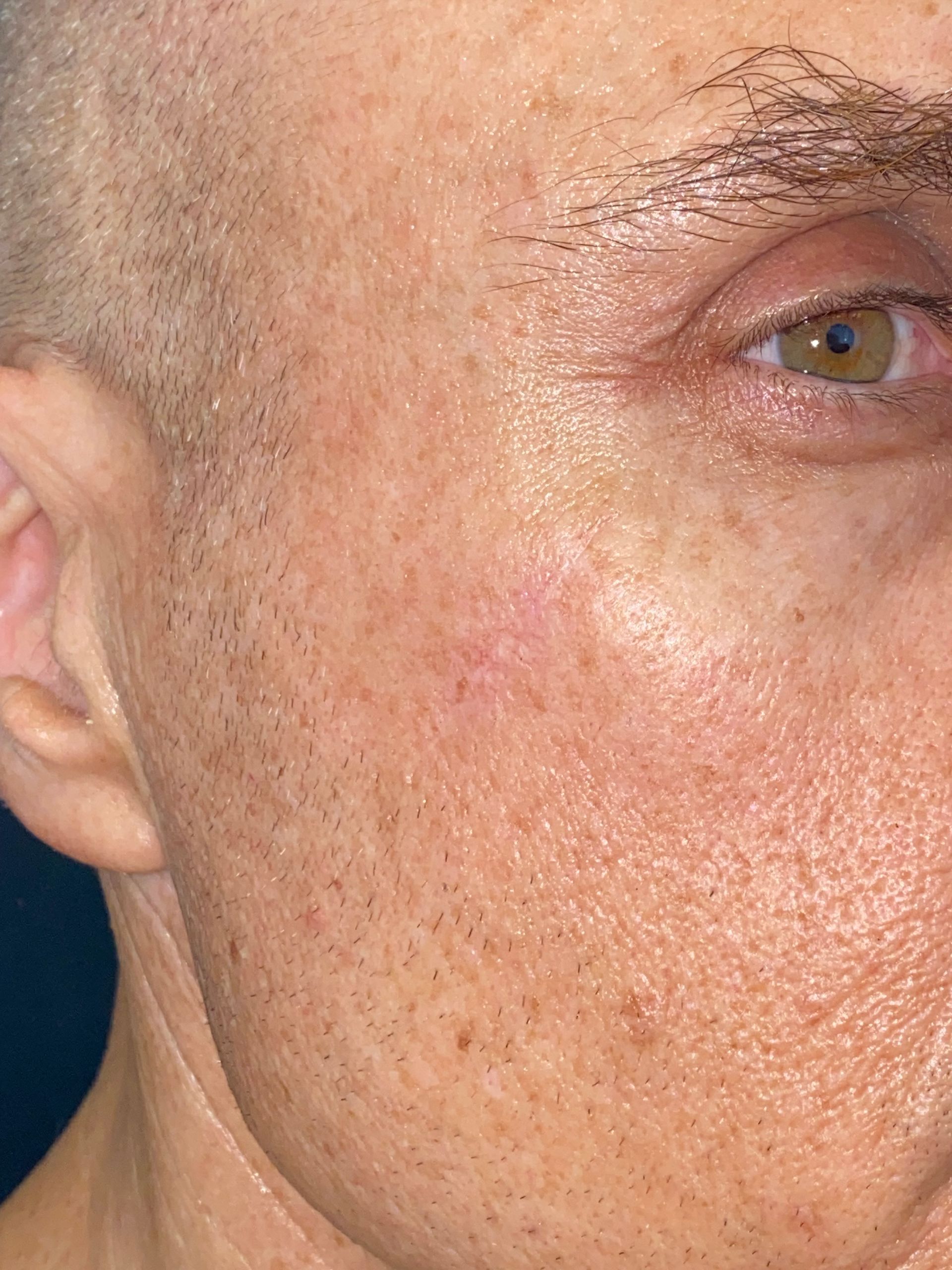 A close up of a man 's face with a red spot on his cheek.
