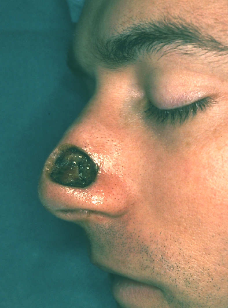 A close up of a man 's nose with a black spot on it.
