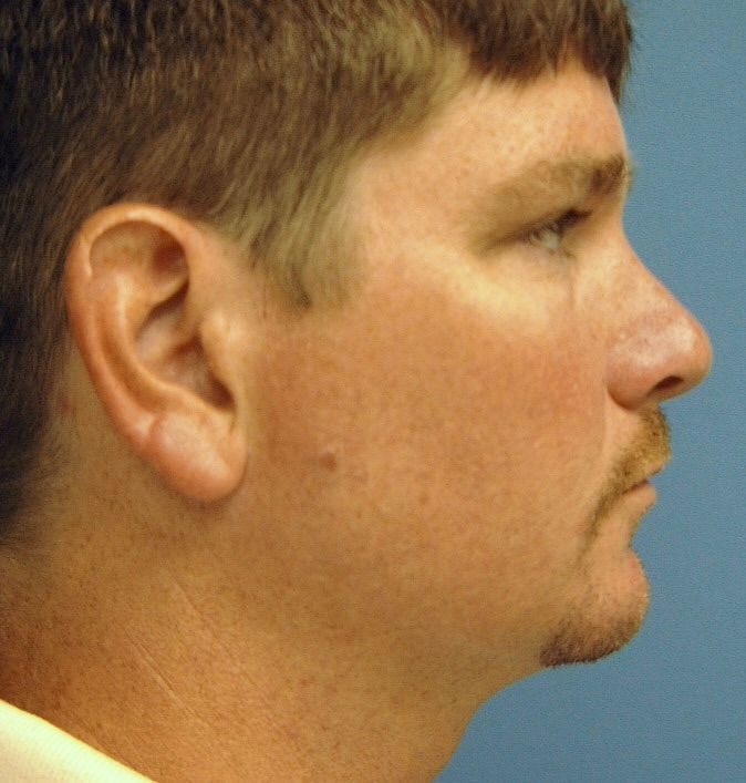 neck lift post op charleston