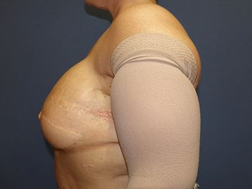 breast reconstruction post op