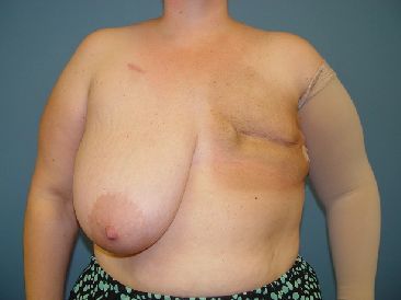 breast reconstruction pre op