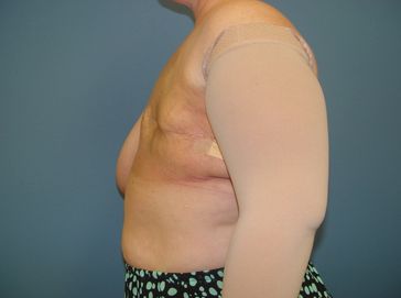 A woman is wearing a pair of compression sleeves on her arms.