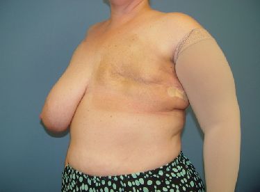 A woman with a prosthetic arm is standing in front of a blue wall.