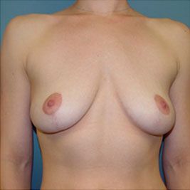 breast lift