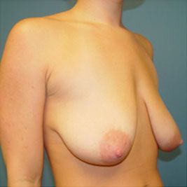 breast lift