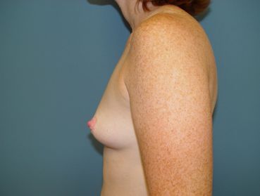 mommy makeover pre op