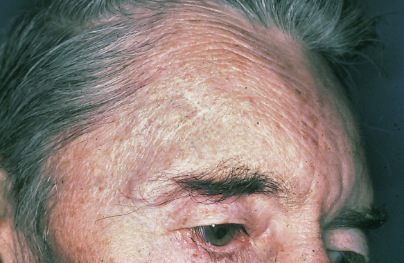 A close up of an older man 's forehead and eye.