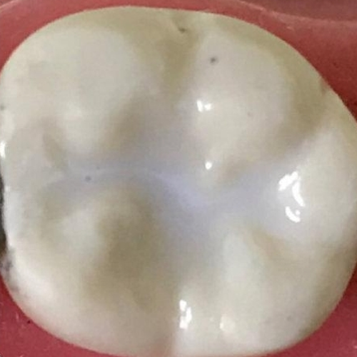 Dental Sealant Applied to Lawrenceville NJ Patient's Tooth for Maximum Protection against decay